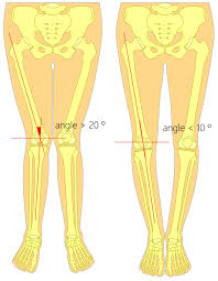 Image result for Functional Leg Length Discrepancy