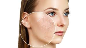 Image result for Dry Skin