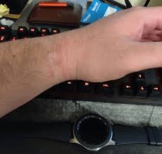 It recommends cleaning after workouts (when your skin will no doubt be sweaty) and after. Samsung Galaxy Watch Owners Complain About Skin Rashes Burns