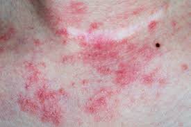 Common Skin Conditions Nhs