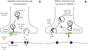 Clostridium botulinum can produce botulinum toxin in food or wounds and can cause botulism. Infant Botulism Review And Clinical Update Pediatric Neurology