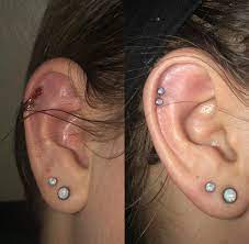 10 Days From Left To Right From Severe Blood Blisters On My Helix Had To Heal It Prior To Changing From The Rings To The Studs I Was About 2 Seconds From
