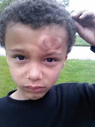 Child runs into pole while playing tag