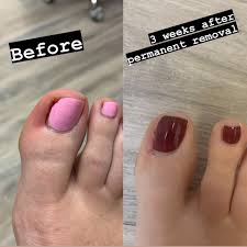 Image result for Toenail Removal