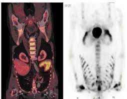 Find the information you need today. Generalized Spread Of Bone Metastases From Prostate Cancer As Shown By Download Scientific Diagram