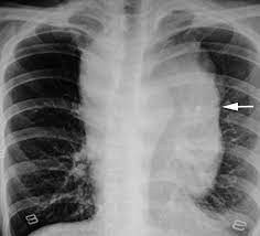 Chest pain pleurisy (inflammation of the pleura) dyspnea (shortness of breath) dry cough Giant Malignant Mesothelioma In The Upper Mediastinum A Case Report