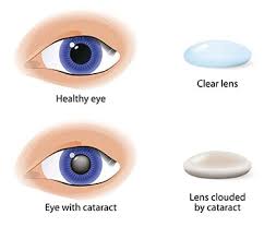 Eye & lasik centre (prof muhaya), kajang, selangor. Services Cataract Surgery Eye Check Lasik Surgery In Malaysia