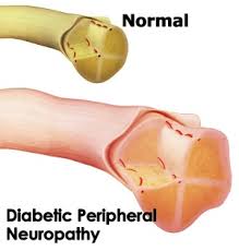 Image result for Peripheral Neuropathy