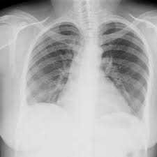 Thorax X Ray Showing Cardiomegaly With A Cardiothoracic Index Of 0 55 Download Scientific Diagram