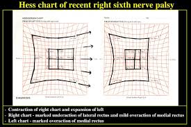 Ppt Ocular Motor Nerve Palsies Powerpoint Presentation