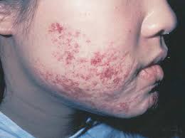 Hemangiomas of infancy