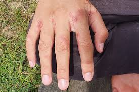 Image result for scabies human children