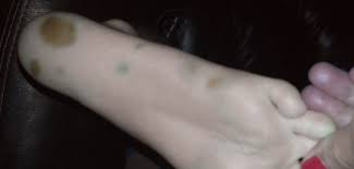 Image result for brown patches on the feet