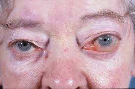 Image result for Proptosis