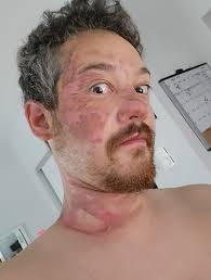 Kitchen Injuries and Burns from Hot Oil and Equipment