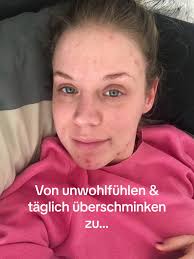 Kommentiere ✨ & ich berate dich super gern #skincare #skincareroutine  #hautprobleme #Unreinehaut #gesundheit #glowup #healthy #pickel