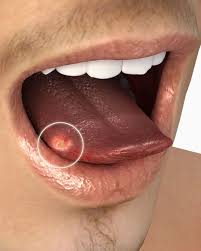 Oral cancers of the mouth and throat account for about 2% of all cancers diagnosed each year in the u.s. Tongue Cancer Symptoms To Indicate You Could Have The Disease Express Co Uk