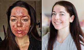 Personal Trainer Shares Her Striking Before And After Acne Pictures In 2020 Before And After Acne Acne Pictures Bad Acne
