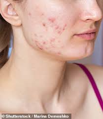 Naturopath Jennifer Jefferies reveals what the pimples