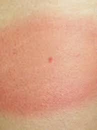 Gehen sie zum kinderarzt, wenn sie sich nicht getrauen oder nicht genau wissen, wie sie die zecke entfernen. Krank Durch Zecken Die Lyme Borreliose Br Wissen