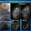 One of the first places breast cancer can spread to is the lymph nodes under the arm on the same side as the breast cancer. 1