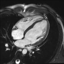 Myocarditis can sometimes be tricky to diagnose. Acute Myocarditis Radiology Case Radiopaedia Org