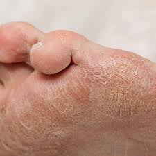 Image result for diabetic toes