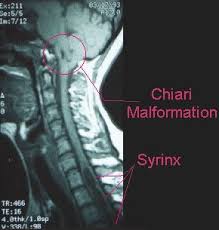 Image From Http Asap Org Wp Content Uploads 2009 10 Mri Jpg Chiari Chiari Malformation Occipital Neuralgia