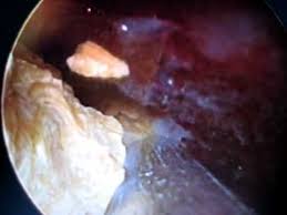 Jom tengok sampai habis dan share pada. Pembedahan Buah Pinggang Batu Karang Pn Leela Abd Rani Part 2 Youtube