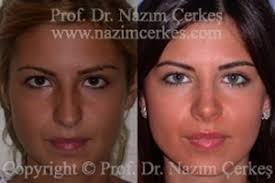 Nose job before and after female. Before After Pictures Rhinoplasty Nose Surgery Breast Face Body Aesthetics Prof Dr Nazim Cerkes