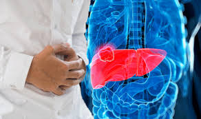 Colon cancer is a type of cancer that begins in the large intestine (colon). Bowel Cancer Symptoms And Signs That It Has Spread To The Liver Spotted These Express Co Uk