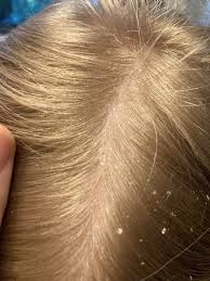 Image result for white scabs on the head in children