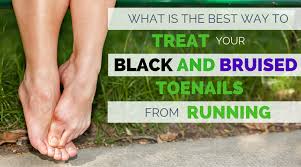 Common ingrown toenail causes include: What Is The Best Way To Treat Black And Bruised Toenail From Running Runners Connect