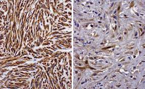 C, biphasic malignant mesothelioma shows a combination of epithelioid and sarcomatoid areas. Sarcomatoid Mesothelioma A Clinical Pathologic Correlation Of 326 Cases Modern Pathology