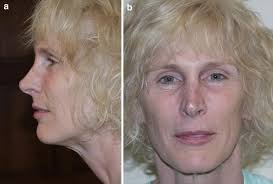Prediction of Face-Lift Outcomes Using the Preoperative Supine Test