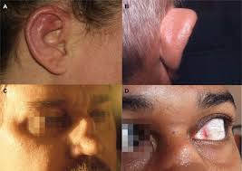 Image result for Relapsing Polychondritis