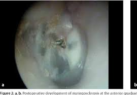 Image result for Myringosclerosis