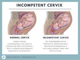 Incompetent Cervix Warning Signs And Symptoms