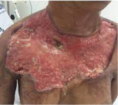 Fournier definition at dictionary.com, a free online dictionary with pronunciation, synonyms and translation. Fournier S Gangrene Of The Shoulder Girdle Intechopen