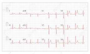 Heart Cardiogram Chart Vector Set Healthy Heart Rhythm Ischemia