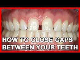 These are best for closing just one or two gaps; Pin On Things For My Teeth