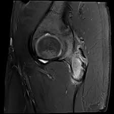 Image result for Hip Apophysitis