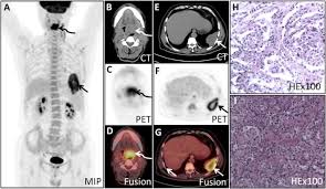 First symptoms of pleural mesothelioma. Tongue Metastasis Was The First Sign Of Malignant Pleural Mesothelioma Detected By Pet Ct Springerlink