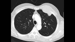 The second most common radiologic finding was an infiltration of the small bowel mesentery by tumor reported in 41% of patients  2 . Malignant Pleural Mesothelioma Evaluation With Ct Youtube