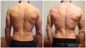 Bilder sagen mehr als tausend worte! Ostarine Mk 2866 Ruckblick Von Bodybuilder