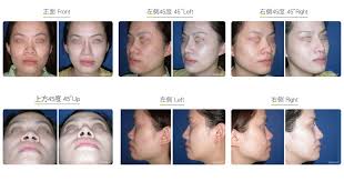 Aug 30, 2021 · clinics in plastic surgery updates surgeons on the latest trends in patient management, providing a sound basis for choosing treatment options. Bulbous Nose Correction Wish Aesthetic Surgery Clinic