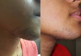 How many cities does 3d lifestyle offer its. Laser Hair Removal For The Face Romeo Juliette Laser Hair Removal