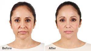 The gold standard to fix marionette folds is to have a surgical facelift. Bellafill Vs Juvederm Comparing The Two Dermal Fillers