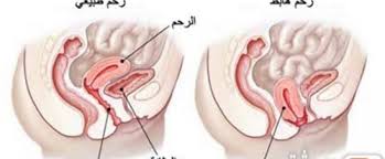 هبوط الرحم أسباب وأعراض وعلاج