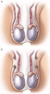 What are the risks of vasectomy? Bilateral Vasectomy Healthdirect
